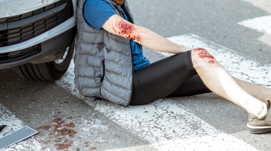 Image of a pedestrian injured in a pedestrian accident sitting on a crosswalk.